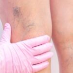 Venous Disease Management