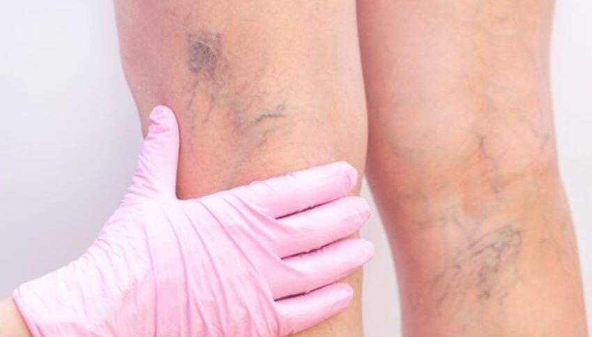 Venous Disease Management