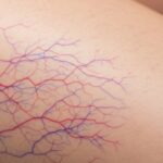best treatment for spider veins
