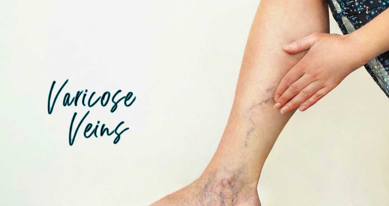 What causes varicose veins