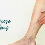 What causes varicose veins