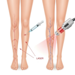 How to Choose a Vascular Surgeon