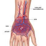 vascular malformation