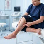 varicose veins symptoms